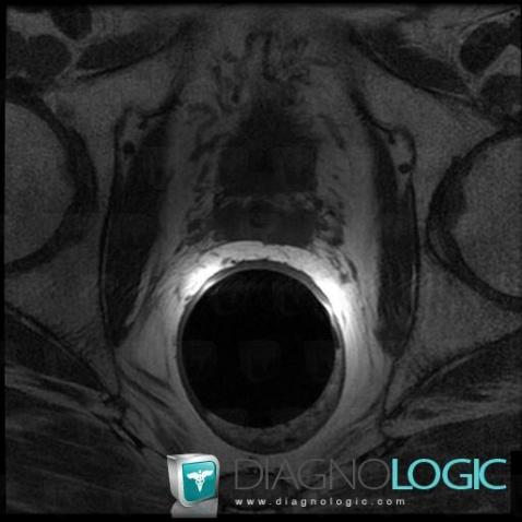 Calcification, Prostate, IRM