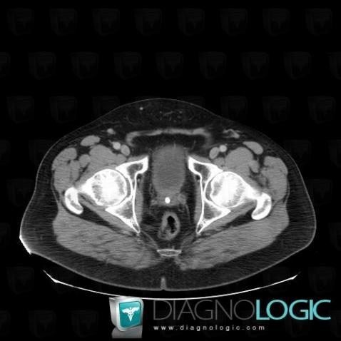 Calcification, Prostate, Scanner