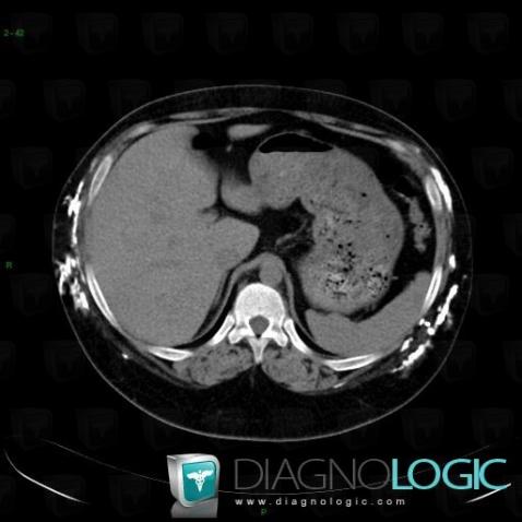 Calcinosis universalis, Abdominal wall, CT