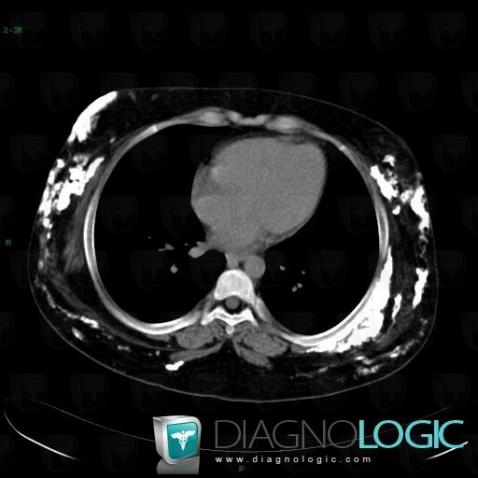 Calcinosis universalis, Chest wall, CT