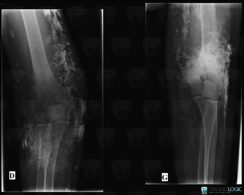 Calcinosis universalis, Medial epicondyle muscles, Other soft tissues/nerves - Elbow, X rays