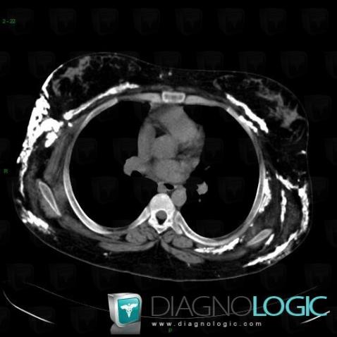 Calcinosis universalis, Muscles - Shoulder, Other soft tissues/nerves - Shoulder, CT