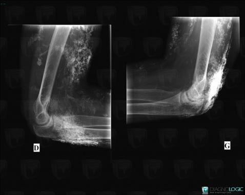 Calcinosis universalis, Other soft tissues/nerves - Arm, X rays