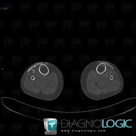 Calcinosis universalis, Other soft tissues/nerves - Knee, CT