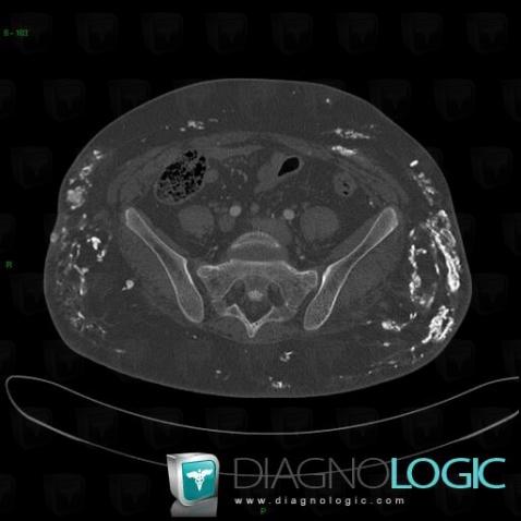 Calcinosis universalis, Other soft tissues/nerves - Pelvis, CT