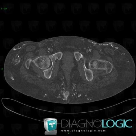 Calcinosis universalis, Other soft tissues/nerves - Thigh, CT