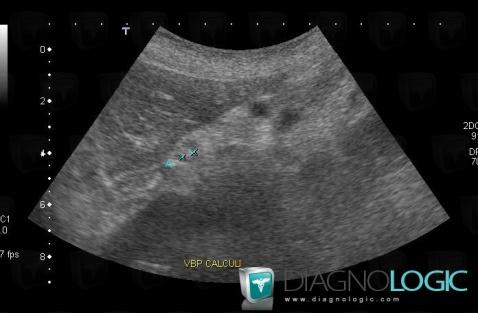 Calcul, Voies biliaires intra et extra hepatiques, Echographie