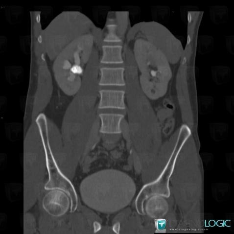 Calculus, Collecting system, CT