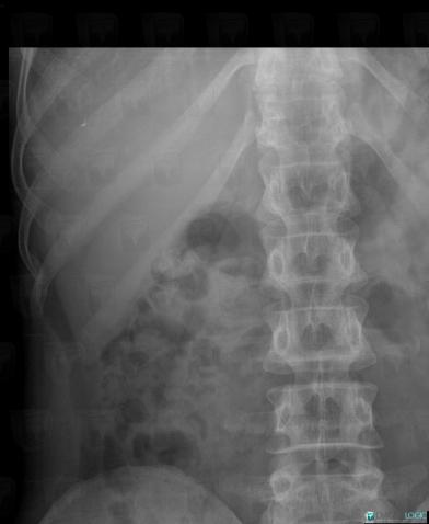 Calculus, Collecting system, X rays