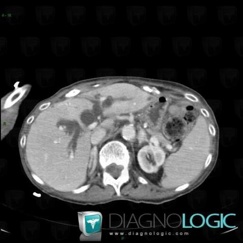 Calculus, Intra and extra hepatic bile ducts, CT