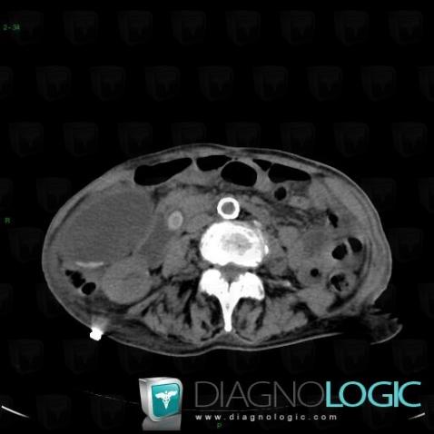 Calculus, Intra and extra hepatic bile ducts, CT