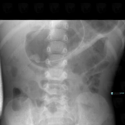 Calculus, Kidney, X rays