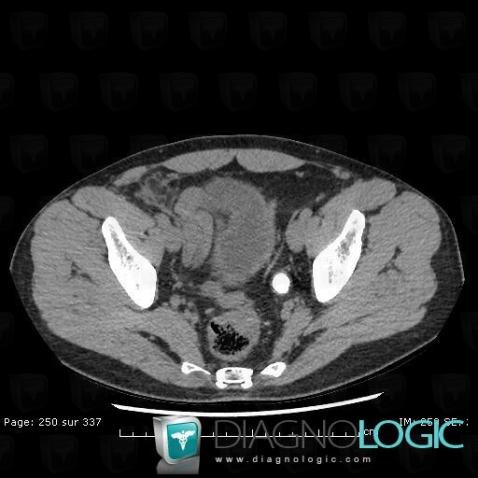 Calculus, Ureter, CT