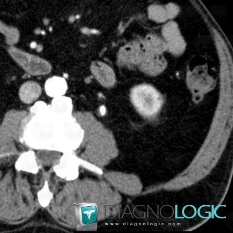 Calculus, Ureter, CT