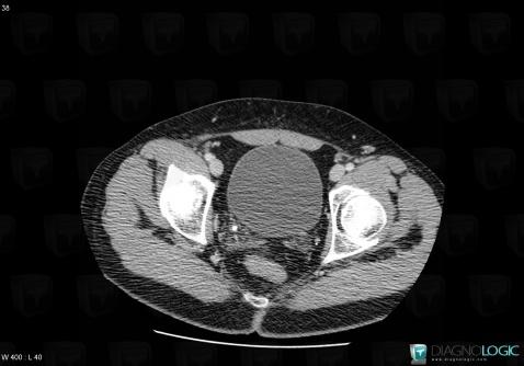 Calculus, Ureter, CT