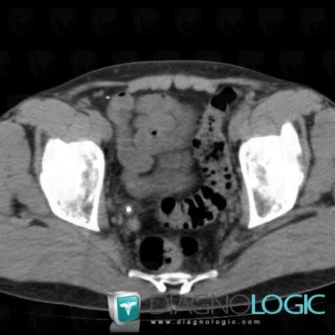 Calculus, Ureter, CT