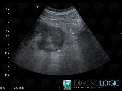 Calculus, Ureter, US