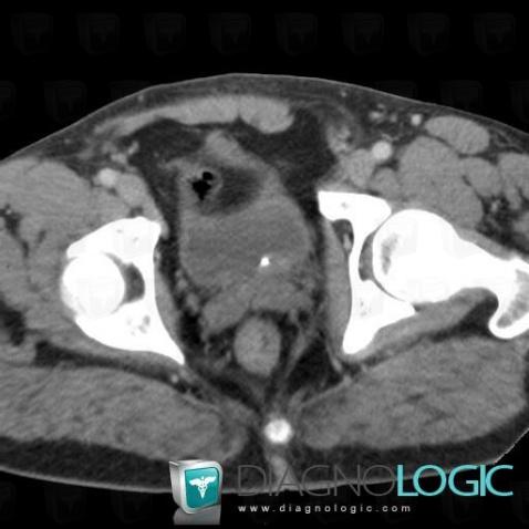 Calculus, Urinary bladder, CT