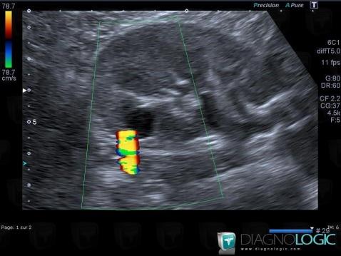 Calyceal diverticulum, Kidney, US