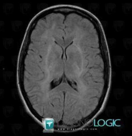 Canavan’s disease, Basal ganglia and capsule, MRI
