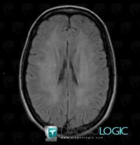 Canavan’s disease, Ventricles / Periventricular region, MRI