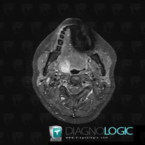 Cancer-base-langue, Oropharynx / Plancher buccal, Pharyngolarynx, IRM
