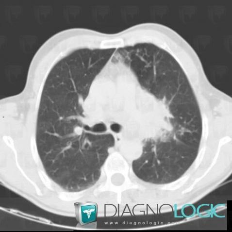 Cancer bronchique-petites cellules, Parenchyme pulmonaire, Scanner