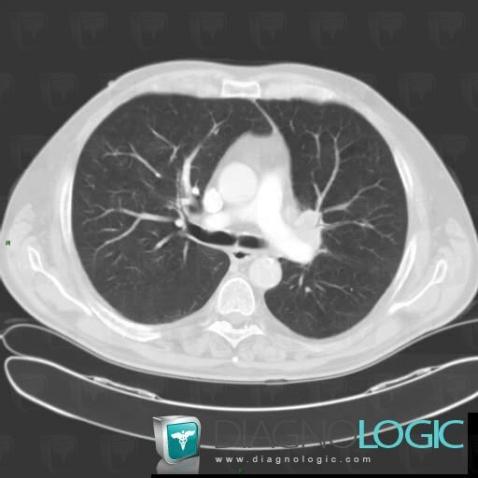 Cancer broncho pulmonaire, Parenchyme pulmonaire, Scanner