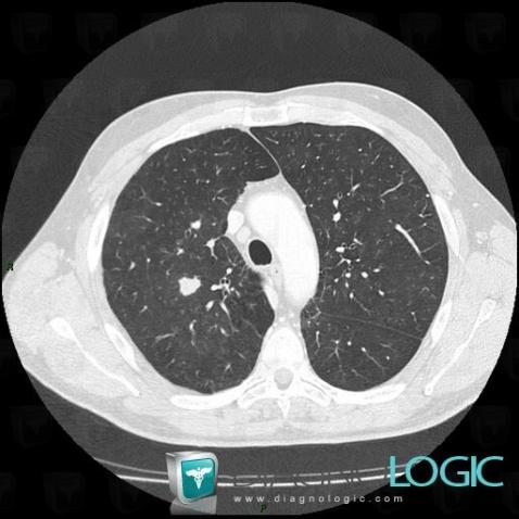 Cancer broncho pulmonaire, Parenchyme pulmonaire, Scanner