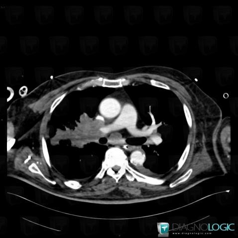 Cancer broncho pulmonaire, Parenchyme pulmonaire, Scanner