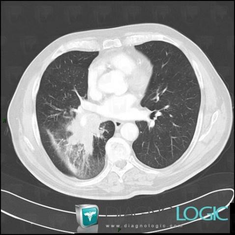 Cancer broncho pulmonaire, Parenchyme pulmonaire, Scanner