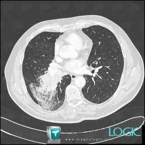 Cancer broncho pulmonaire, Parenchyme pulmonaire, Scanner