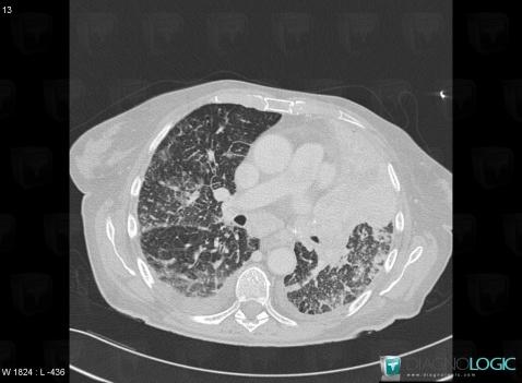 Cancer broncho pulmonaire, Parenchyme pulmonaire, Scanner