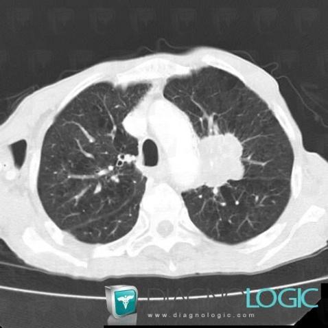 Cancer broncho pulmonaire, Parenchyme pulmonaire, Scanner