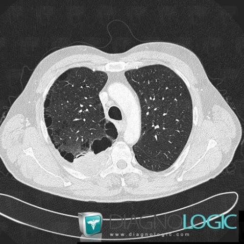 Cancer broncho pulmonaire, Parenchyme pulmonaire, Scanner