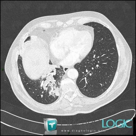 Cancer broncho pulmonaire, Voies aériennes, Scanner