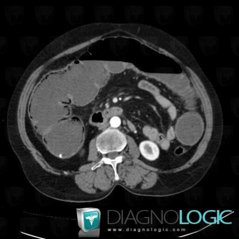 Cancer-colon, Colon, Scanner