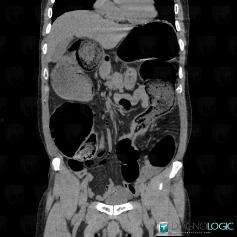 Cancer-colon, Colon, Scanner