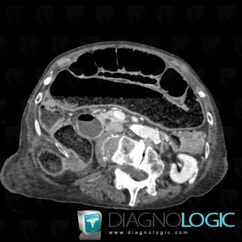 Cancer-colon, Intestin grêle, Colon, Scanner