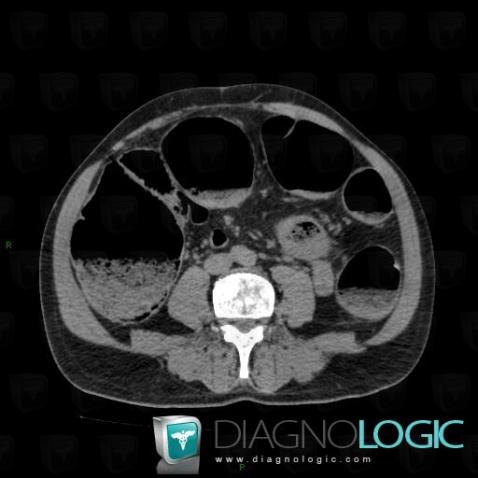 Cancer-colon, Intestin grêle, Colon, Scanner