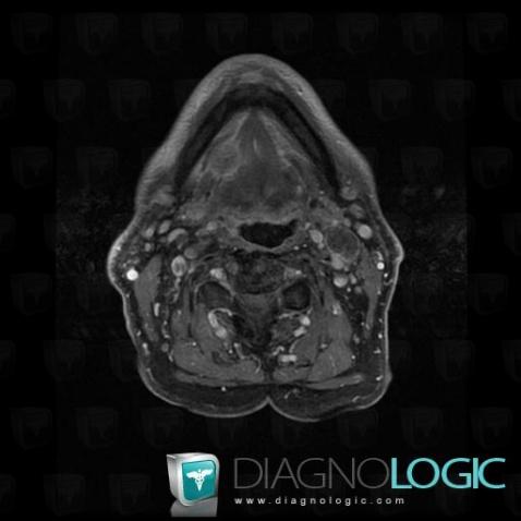 Cancer de-langue, Oropharynx / Plancher buccal, IRM