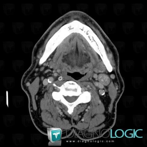 Cancer de-langue, Oropharynx / Plancher buccal, Scanner