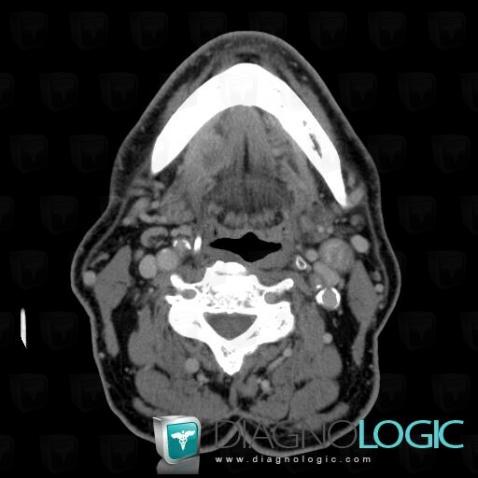 Cancer de-langue, Oropharynx / Plancher buccal, Scanner