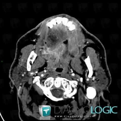 Cancer de-langue, Oropharynx / Plancher buccal, Scanner