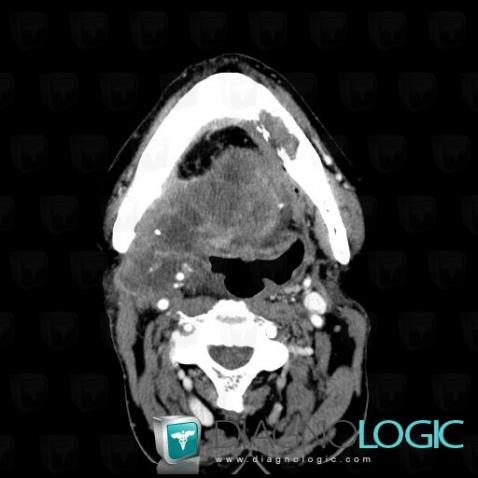 Cancer de-langue, Oropharynx / Plancher buccal, Scanner