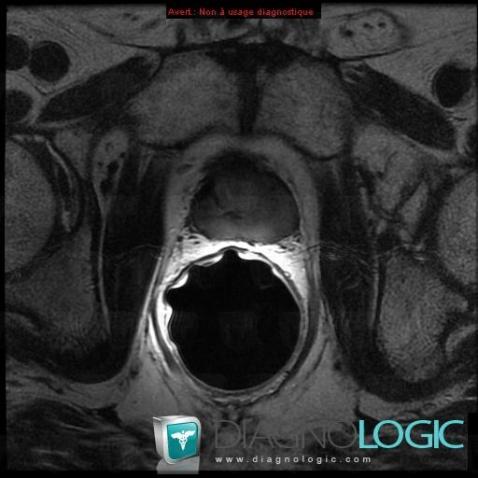 Cancer de-prostate, Prostate, IRM
