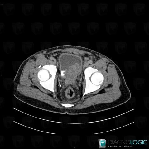 Cancer de-prostate, Vessie, Prostate, Scanner