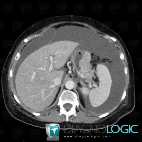 Cancer gastrique, Estomac, Scanner