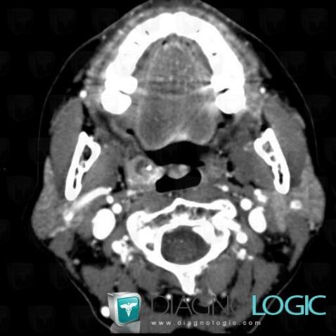 Cancer-l'amygdale, Oropharynx / Plancher buccal, Scanner