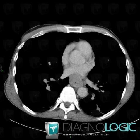 Cancer-l'oesophage, Oesophage, Scanner